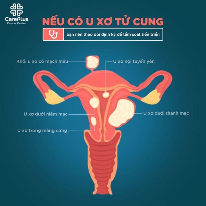 Living with uterine fibroids