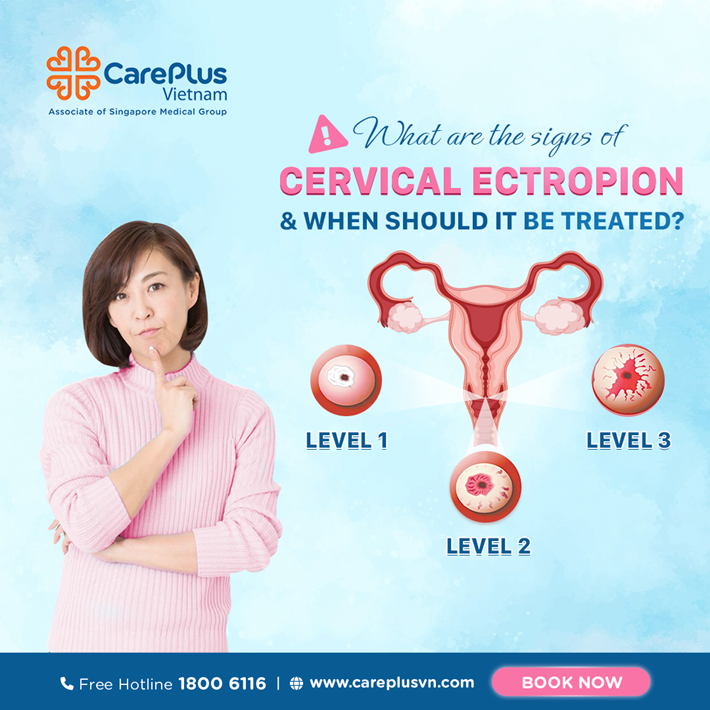 What Are the Signs of Cervical Ectropion and When Should It Be Treated? 