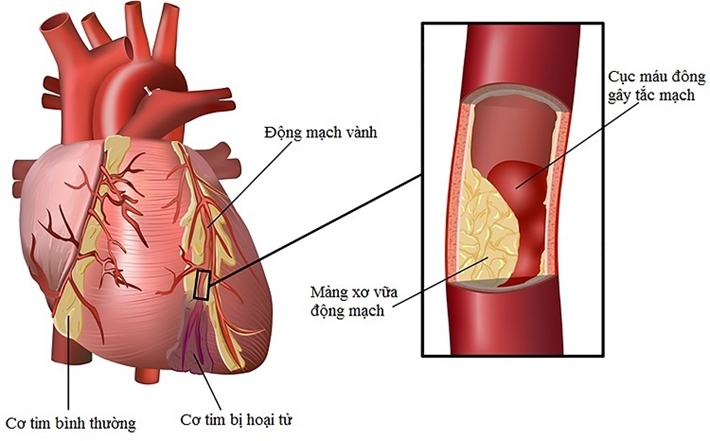 Tim Mạch Vành: Nguyên Nhân, Triệu Chứng và Phương Pháp Điều Trị