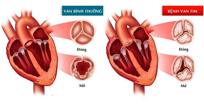 Open-heart valve disease: early symptoms and treatment