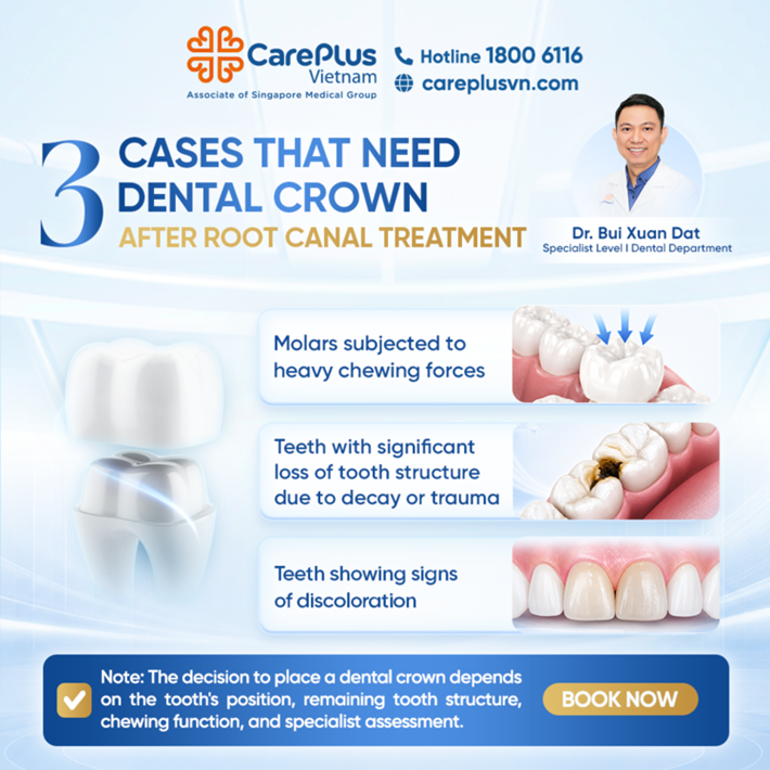 🦷 3 CASES WHERE A DENTAL CROWN IS RECOMMENDED AFTER ROOT CANAL TREATMENT 