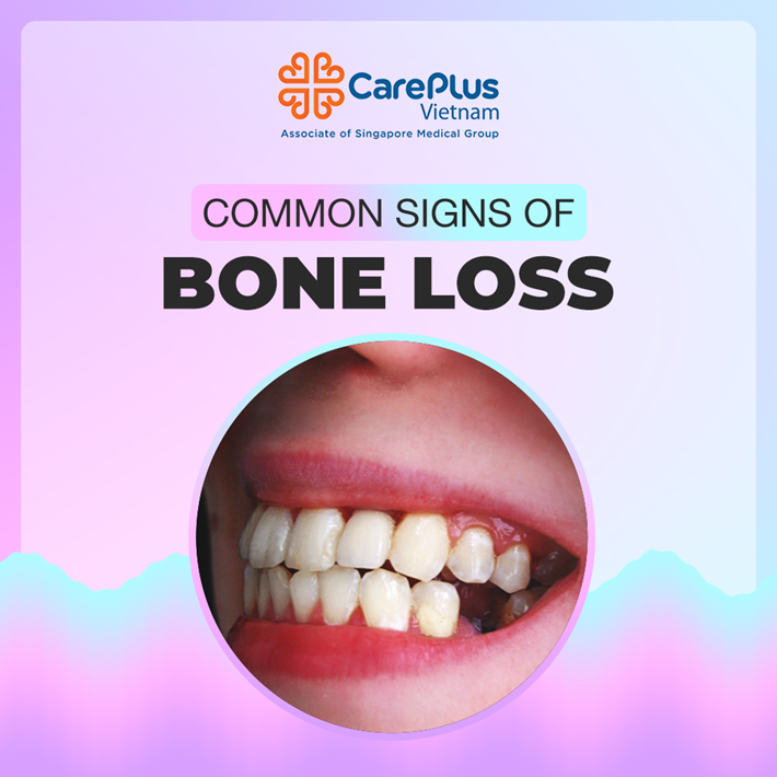 Common signs of bone loss