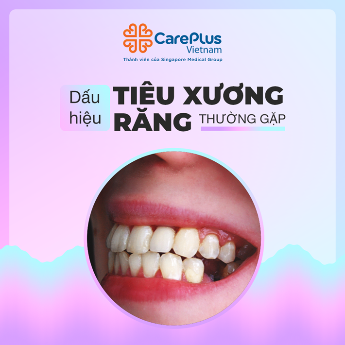  Dấu hiệu tiêu xương răng thường gặp 