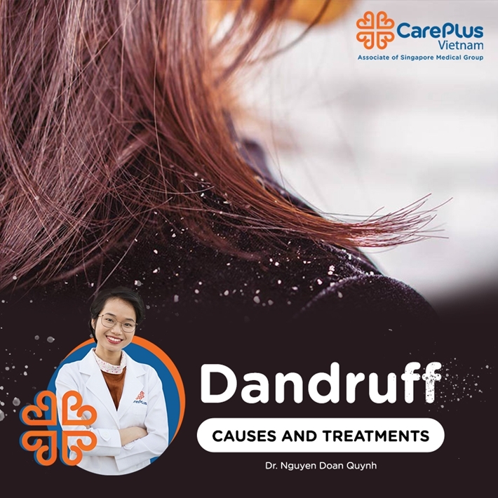Dandruf: Causes and Treatments