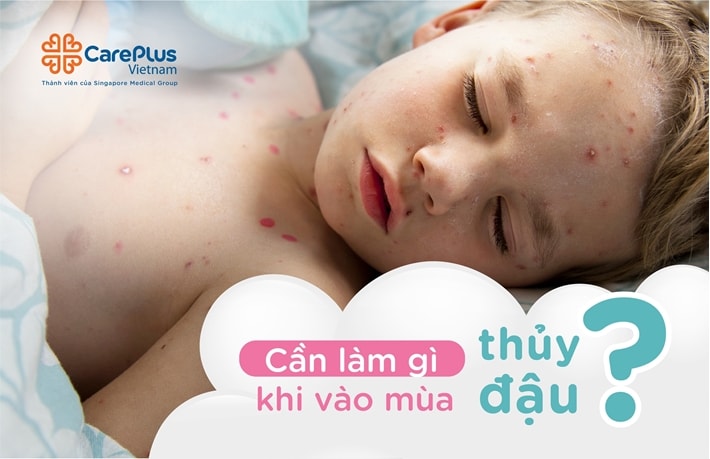 What To Do During Chickenpox Season?