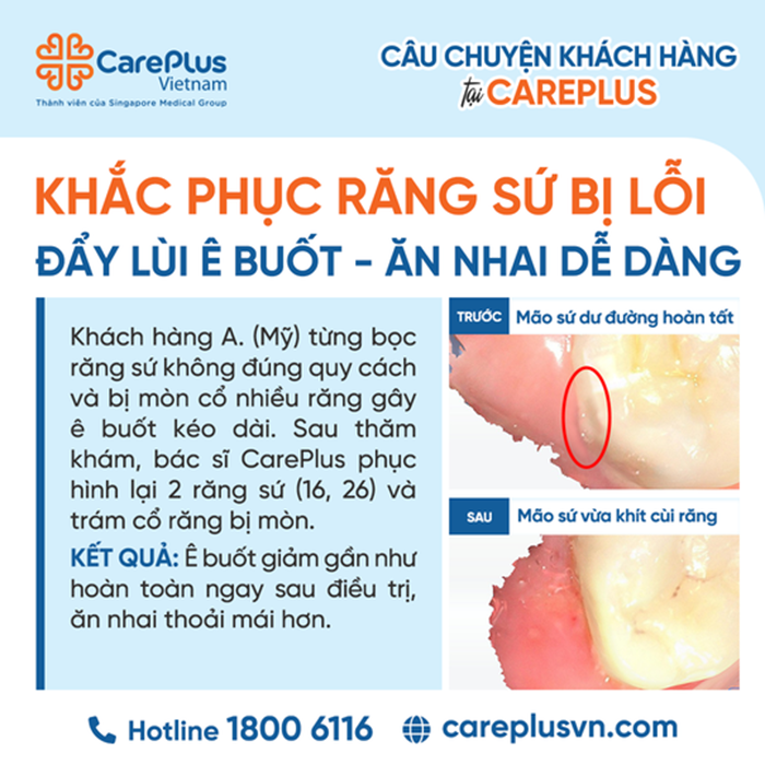 KHẮC PHỤC RĂNG SỨ BỊ LỖI – ĐẨY LÙI Ê BUỐT VÀ ĂN NHAI DỄ DÀNG CÙNG CAREPLUS 