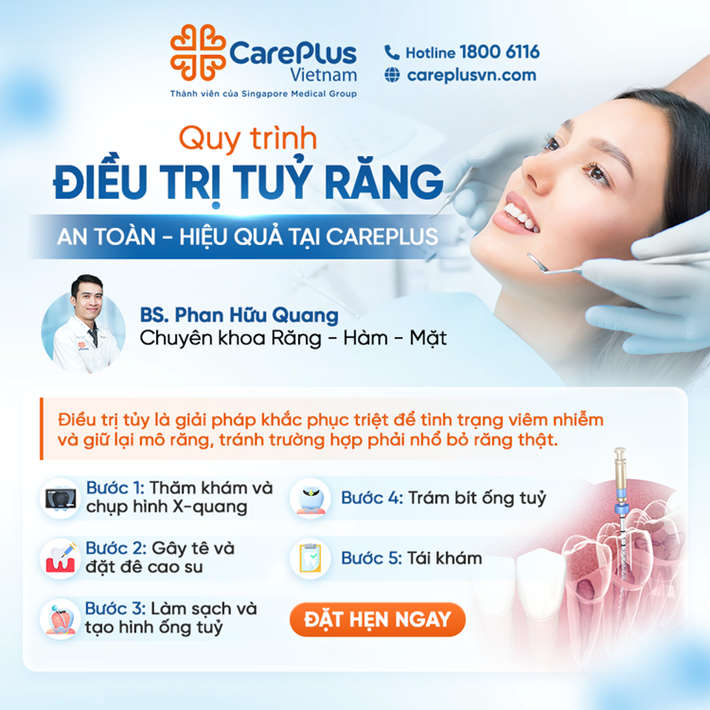 QUY TRÌNH ĐIỀU TRỊ TỦY RĂNG AN TOÀN - HIỆU QUẢ TẠI CAREPLUS