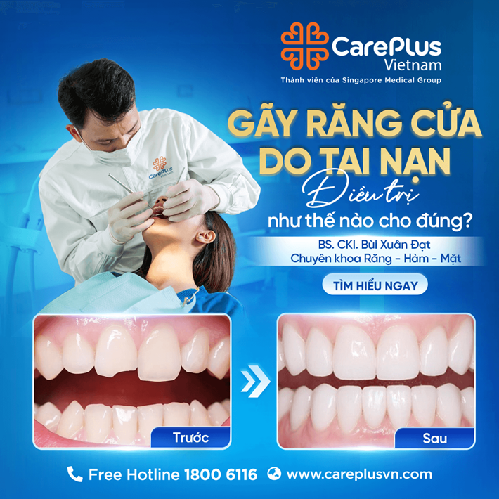 GÃY RĂNG CỬA DO TAI NẠN - ĐIỀU TRỊ NHƯ THẾ NÀO CHO ĐÚNG? 