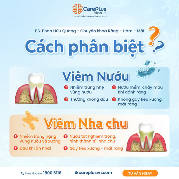 PHÂN BIỆT VIÊM NƯỚU VÀ VIÊM NHA CHU