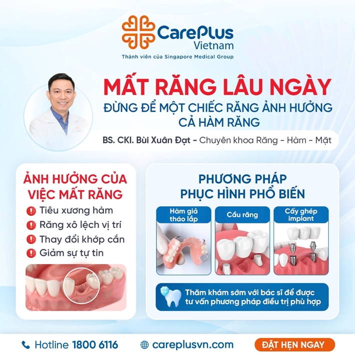 MẤT RĂNG LÂU NGÀY: ĐỪNG ĐỂ MỘT CHIẾC RĂNG ẢNH HƯỞNG CẢ HÀM RĂNG 