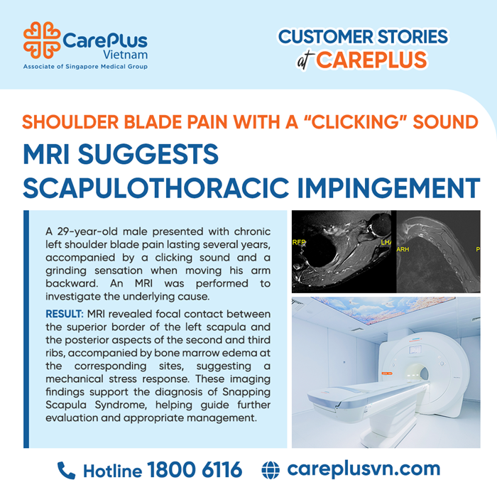 PAINFUL CLICKING AROUND THE SHOULDER BLADE: THE ROLE OF MRI IN DETECTING SCAPULOTHORACIC IMPINGEMENT 