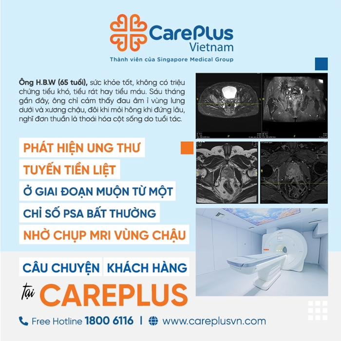 PHÁT HIỆN UNG THƯ TUYẾN TIỀN LIỆT Ở GIAI ĐOẠN MUỘN TỪ MỘT CHỈ SỐ PSA BẤT THƯỜNG 