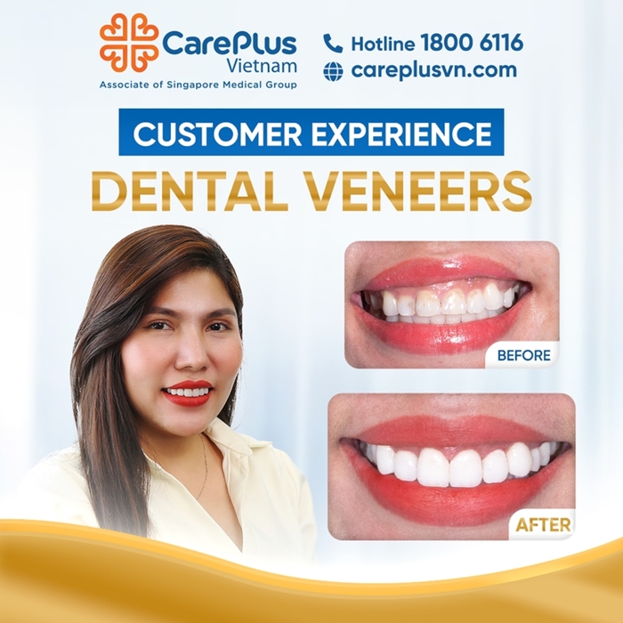 EXPERIENCE DENTAL VENEERS – ACHIEVE A PERFECT SMILE AT CAREPLUS 