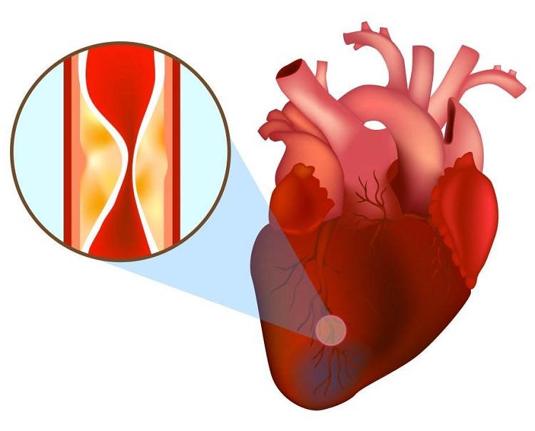 Sự khác biệt bệnh nhồi máu cơ tim là gì? 