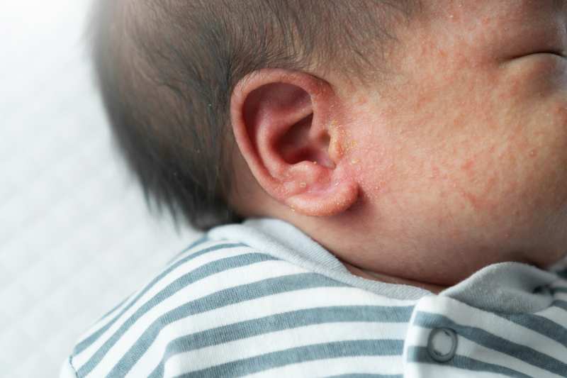 Baby Heat Rash: What to Know about Prickly Heat (Miliaria)