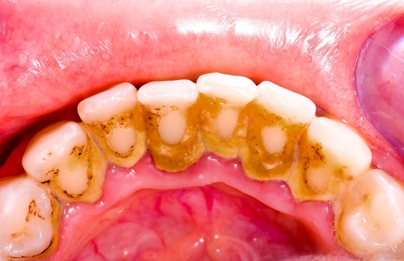 Mảng bám tích tụ lâu ngày trong cao răng là nơi trú ngụ của vi khuẩn -- Những kinh nghiệm trước khi đi lấy cao răng mà bạn nên biết --