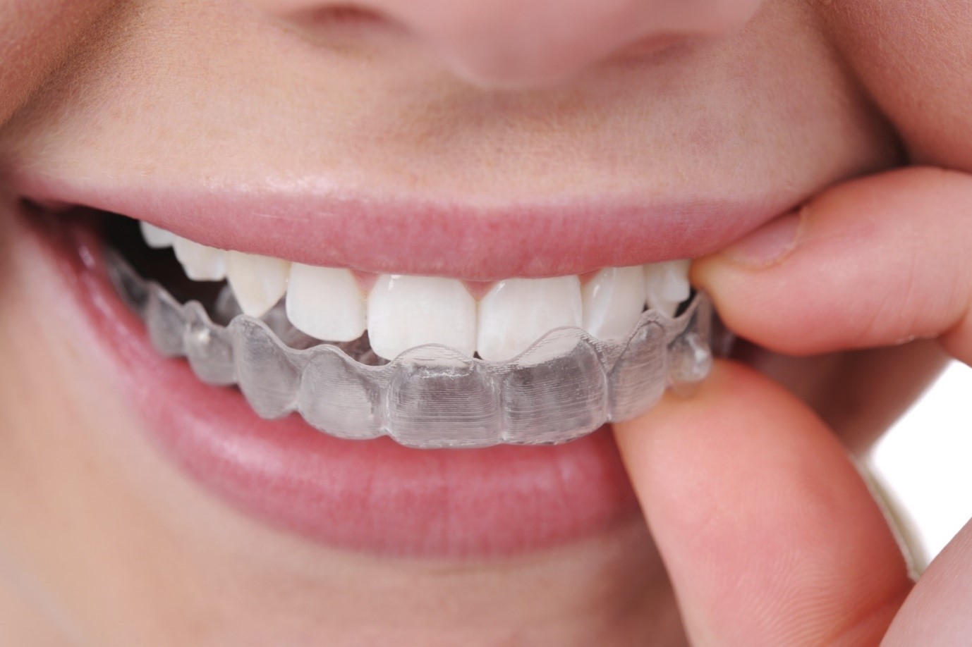 tẩy trắng răng có hại không 
