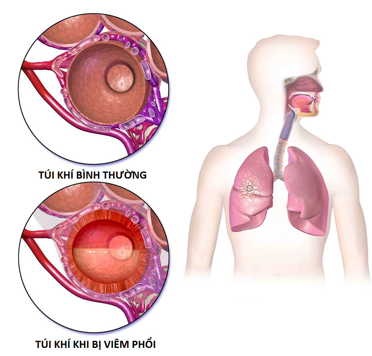 Viêm phổi - Nguyên nhân gây tử vong hàng đầu ở trẻ em